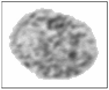 Medisinsk mikroskopi Eksemplet viser mikroskopi-bilder av cellekjerner fra kreftsvulst i eggstokkene (ovarie) for en pasient med god prognose (venstre) og en pasient med dårlig prognose (høyre).