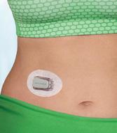 Dexcom G5 (og fremtidige versjoner) er godkjent for å ta behandlingsbeslutninger på sensorverdier, som i de fleste tilfeller kan redusere mengden blodsukkermålinger 2.