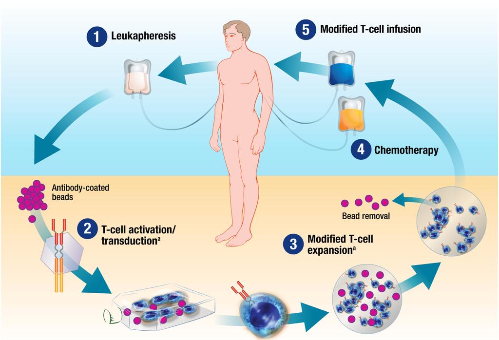 CTL019 behandling i praksis Genmodifiserte egne T celler gis tilbake til pasienten 1. Leukaferese: Høster lymfocytter fra pasienten 2. T celler aktiveres og tranduseres med CD19 CAR 3.