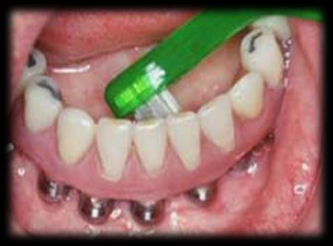 for å holde tannerstatningene ved like. Ofte blir det enkle og billigere løsninger som gjøres da tannpussen ikke er optimal.