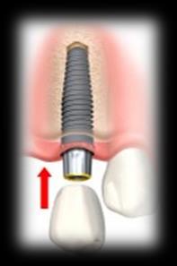 Implantat /bro Ved renhold av tannerstatninger; spør tannhelsepersonell for god og riktig veiledning Proteser.
