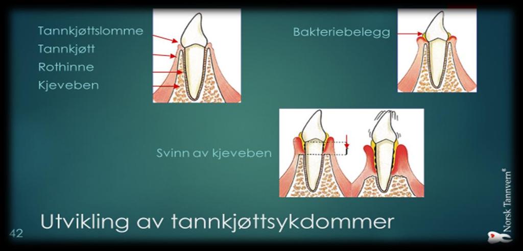 Periodontitt (tannløsningssykdom). Periodontitt er en betennelsessykdom som rammer tennenes feste.