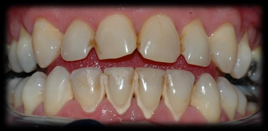 Hvis dette ikke oppdages i tid (rutinemessige undersøkelser inklusive lommedybdemåling) og behandles kan det innebære en økt risiko for at tannen på sikt løsner og går tapt. Tannstein.