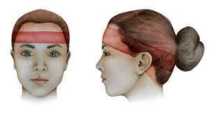 Menstruell migrene Migrene uten aura Def: i perioden 2 dager før til 2 dager etter 1.