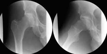 TEMA Bilde 2. Etter distraksjon av hofteleddet går man først inn med nål under gjennomlysningskontroll (Fra: Dienst M. Hüftarthroskopie. Lagerungs- und Distraktionstechnik. Orthopade.
