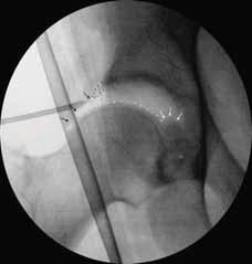 hofteleddet. Ved pincer impingement fjernes fremre kant av acetabulum med fres. Dersom labrum er intakt kan denne tas av og refikseres etterpå med suturankere.