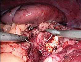 Det er vanskelig å unngå å fjerne noe av det perirenale fettet for å få visualisert tumor.