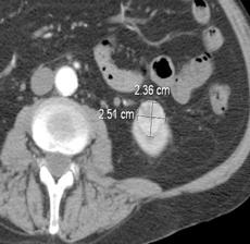 Figur 3. CT som viser tumor i øvre nyrepol på venstre side som ble behandlet med CSAK 8658S, 5-10MHz.