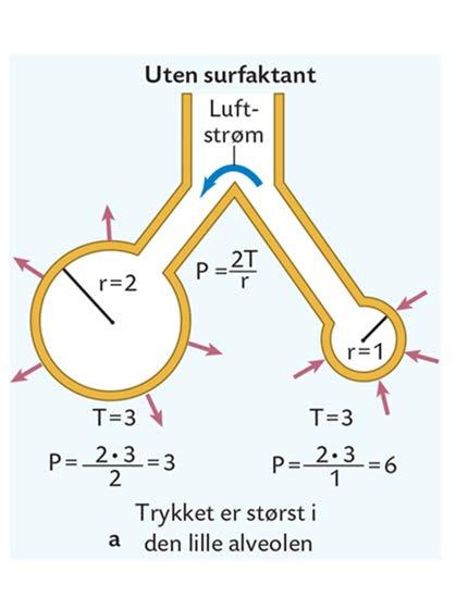 Alveolene forskjellig størrelse Lik overflatespenning trykket størst i de minste alveolene