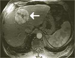 Hepatocellolært carcinom: