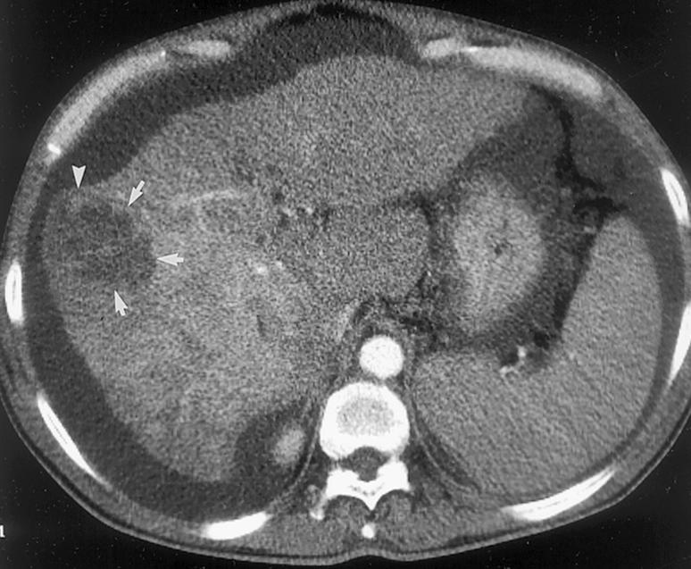 Reseksjon av HCC Cirrhose Risiko for leversvikt etter reseksjon Kun reseksjon ved Childs A God funksjon, ofte PVE Risiko består Ny tumor Cirrhose øker risiko for all kirurgi Pasientens