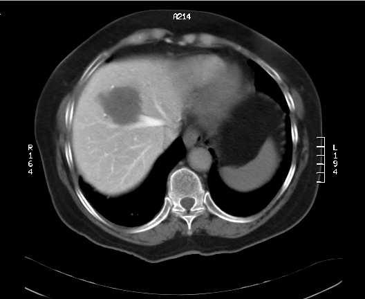 Lever: To hovedscenarier HCC 90% av alle primære maligne svulster Cirrhose Viral hepatitt, Alkohol, fettlever (obesitas) Noen få