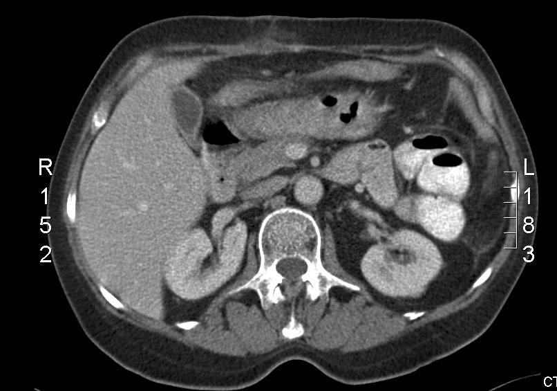 Normal CT Caput