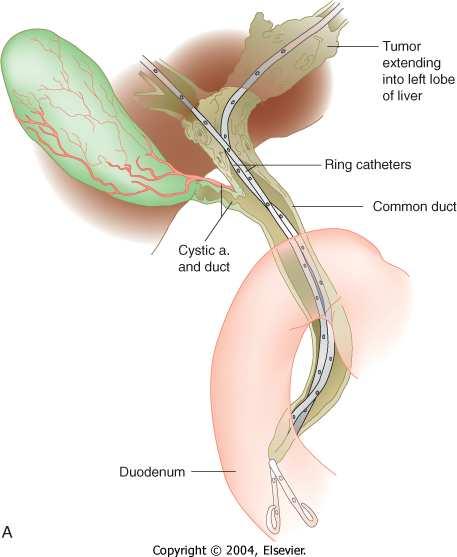 Klatskintumor Aggressive cancere 20 % 5-års overlevelse?