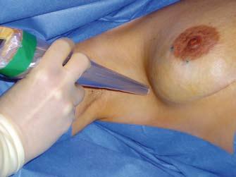 ved å lage et nytt bryst av eget vev (se innlegg fra plastikkirurg Sverre Harbo).