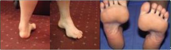 av fot pes cavus og klo-tær Nerver mye sårbar for kompresjon» - hud under foten: kald, rødt, svette, - parestesi (hyperestesi, hyperalgesi, allodyni), - smerter