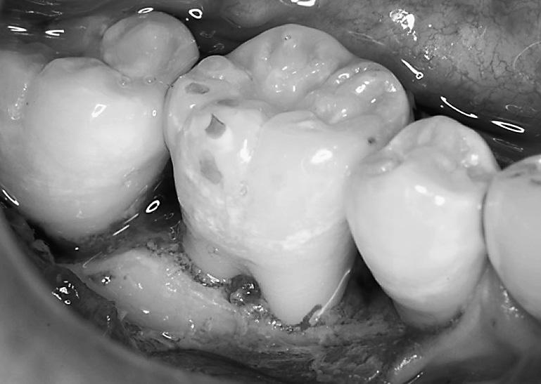 10,000 0 0 0 0 0 Pg 0 0 0 0 0 0 IP, initial periodontal therapy; AT, antimicrobial therapy; SPT, supportive periodontal therapy radiographs, and the results of microbiological assessment with the aim