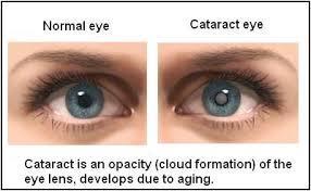 Syn Øyesykdommer vanlig ved