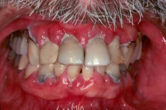 Fokus på mulig(e) årsak(er) for samtidig årsaksrettet behandling Tannslitasje Tannluke Partiell tannløs