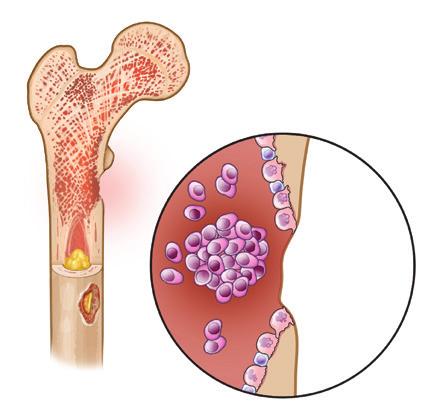 IMF er her for å hjelpe deg International Myeloma Foundation (IMF) har forpliktet seg til å gi opplæring og støtte til myelomatosepasienter og deres familier. Dette gjør vi via vårt nettsted myeloma.