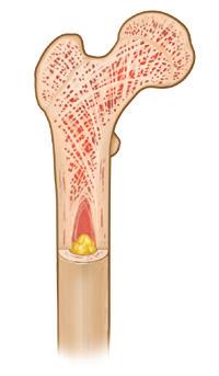 Osteocytt Figur 4.