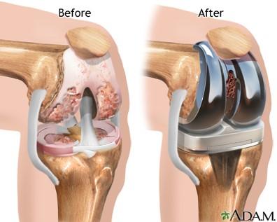 Kneprotese Utføres ved fremskreden primær eller sekundær artrose, samt ved revmatisk artrose.