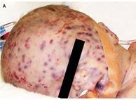 (70,5%) Publisert 2013 Congenital HCMV transmission