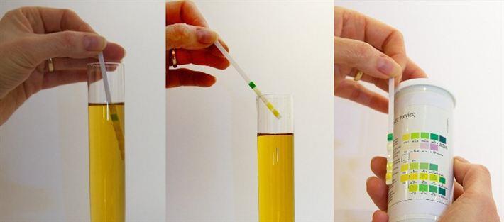 Tre årsaker til bakterier i urinen 1. Asymptomatisk bakteriuri (ASB) 2.