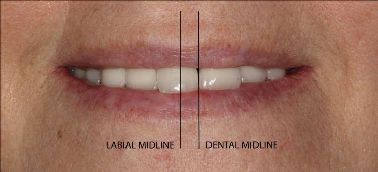 Labial midtlinje