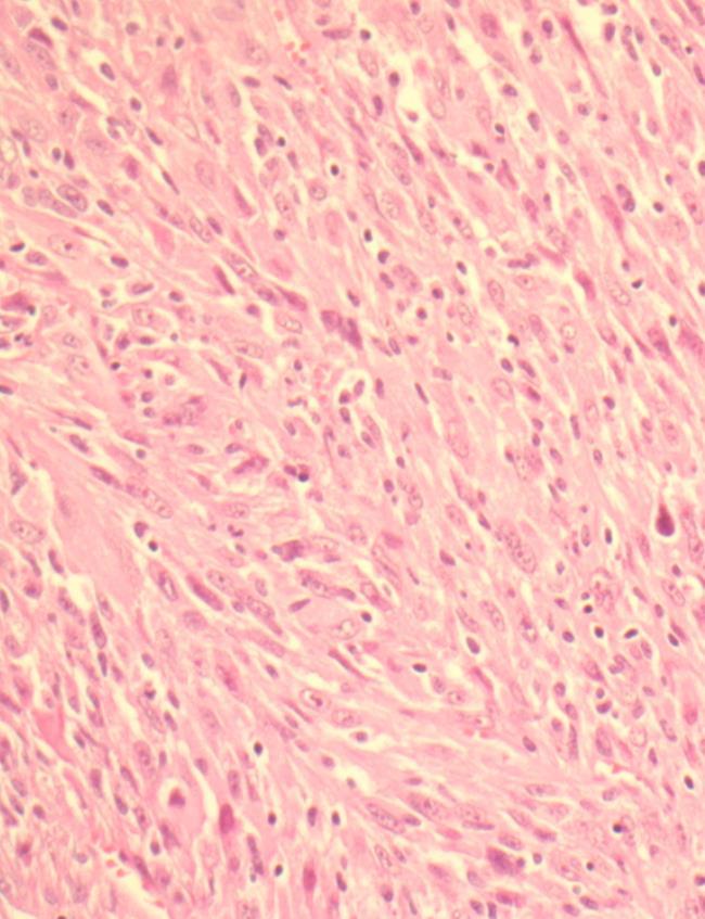 Cellerik tumor Spolformede celler Stedvis granulært og småvakuolisert eosinofilt