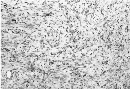 plasmacellegranulom, inflammatorisk