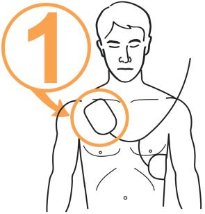 4.3 Defibrillering i Voksen-modus Trinn 1: Plasser putene på pasienten. 1 Fjern pute 1 fra det enkle bakstykket og fest puten øverst på pasientens bryst, som vist nedenfor.