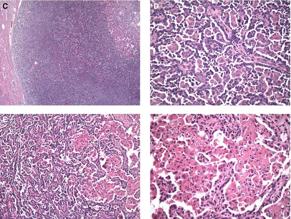 Bifasisk skvamoid alveolært nyrecellekarsinom Nylig beskrevet renal tumor som er histologisk og genetisk assosiert med papillært nyrecellekarsinom Foreslått som egen subtype av papillært