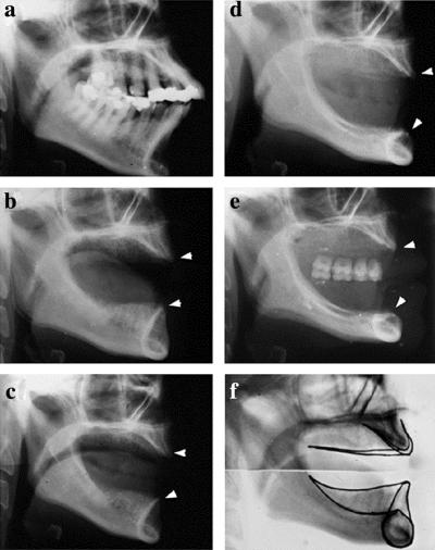 Kjevebein-endringer etter tann-tap Røntgenologiske funn Pre-ekstraksjon (a) 17 år postekstraksjon 3 mnd.