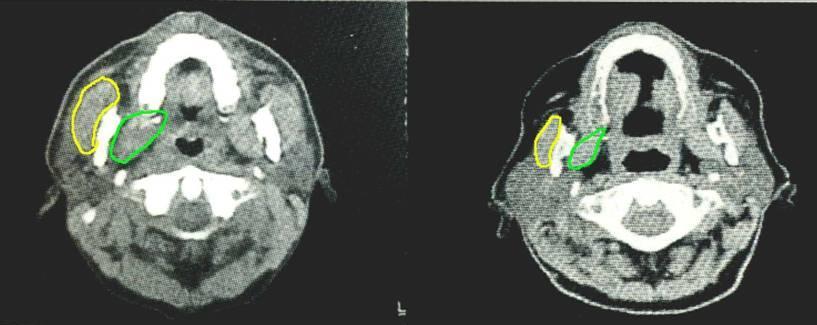 Neuromuskulære endringer av tyggemuskulaturen med alder ungt individ gammelt individ Computer tomografi (CT) scan av