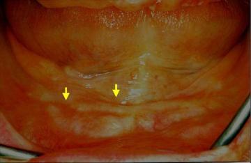 Orale bløtvevs-endringer med alder Epitellaget blir tynnere og mindre differensiert Slimhinnen atrofierer med alder Tynn