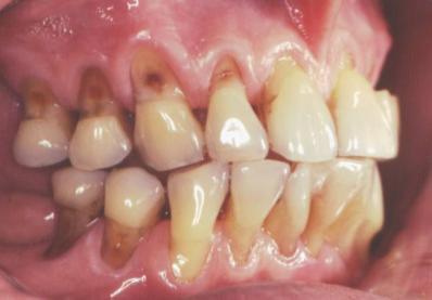 Periodontium, endringer med alder I en ren munn: forsnevring av periodontalligamentrommet, evt.
