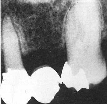 Endodontium, fysiologiske aspekter Røntgenologise endringer