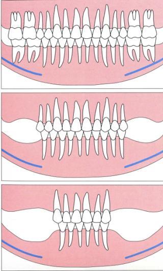 SDA- Shortened Dental arch