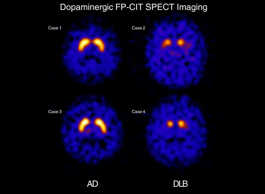 Indikerende biomarkører Redusert dopamintransporter opptak i basale ganglier ved SPECT eller PET Unormalt lavt