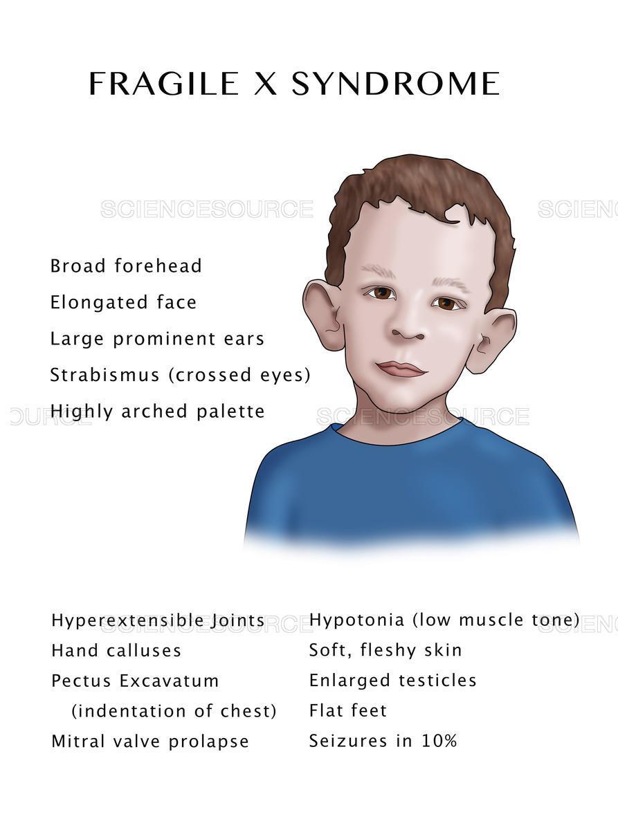 Fragilt X syndrom Vanligste arvelige form for utviklingshemming hos menn Mer vanlig og mer alvorlig hos menn enn kvinner