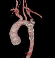 Behandling av aortasykdom med skalpell eller kateter? Ikke enten-eller, men både-og tema Behandling av ervervet aortasykdom hos voksne er en stor og økende andel av virksomheten ved vår avdeling.