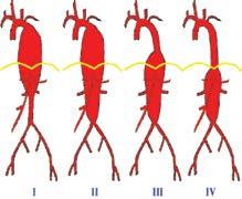 (Bilde kopiert fra J Vasc Surg 2006;44:404) tema Figur 3: Aneurisme i aorta descendens behandlet med stentgraft Fra 2000- april 2007 har vi gjort 70 endovaskulære prosedyrer i aorta descendens hos 60