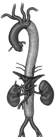 hvor langt distalt sykdommen strekker seg. Intercostalarterier, nyre- og intestinalarterier reimpanteres suksessivt i protesen. (fig. 7) Figur 7: Thorakoabdominalt aneurisme, Crawford type 2.