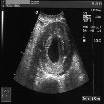 Åpen kirurgisk behandling av abdominale aortaaneurysmer (AAA) AAA er fremfor alt en sykdom som rammer eldre menn.