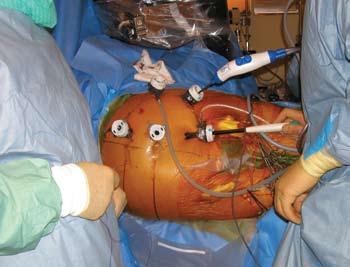 3) Jerome Cau fulgte prospektivt 95 AAA pasienter i 2mnd og fant sammenlignbare resultater med åpen aortakirurgi.