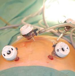 Implementering av laparoskopisk assistert kirurgi for kolonkanser ved Stavanger Universitetssykehus Laparoskopisk kirurgi for kolorectalkanser ble allerede utført på 1990 tallet, men rapporter om