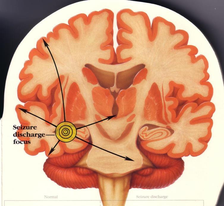 Fokale anfall - Anfall som starter i nervenettverk begrenset til en hjernehalvdel -