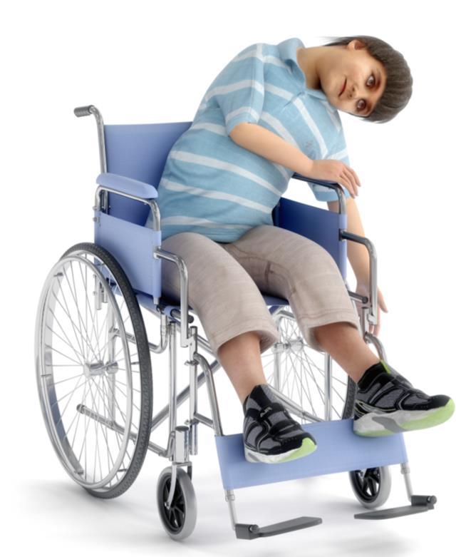 Så hva skjer med barn som har relativt store funksjonsnedsettelser Ulik grad av muskeltonus Nedsatt stabilitet og bevegelse Vanskelig å komme ut av en stilling Øker risikoen for