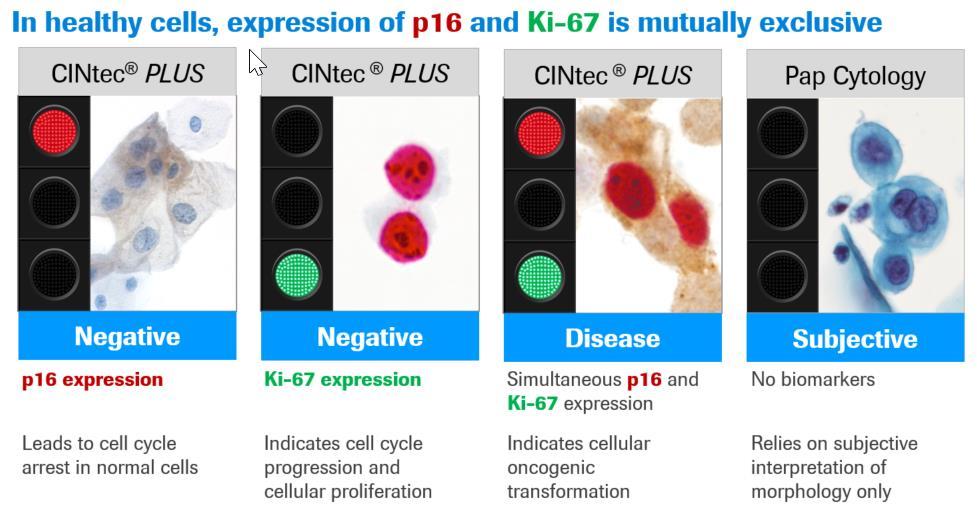 2. Kort beskrivelse av metoden som foreslås vurdert: Metoden er en dobbelfarging av cytologisk materiale, Ki-67 og p16, immunhistokjemisk metode, (CINtec PLUS).